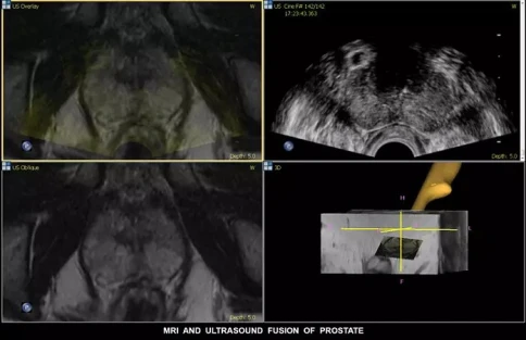 УЗИ аппарат Philips EPIQ PercuNav фото 4