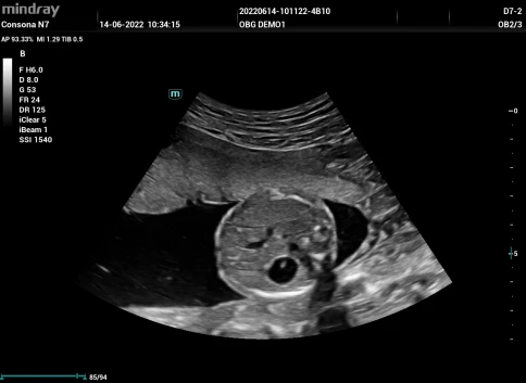 Ультразвуковая система Mindray Consona N7Q фото 19