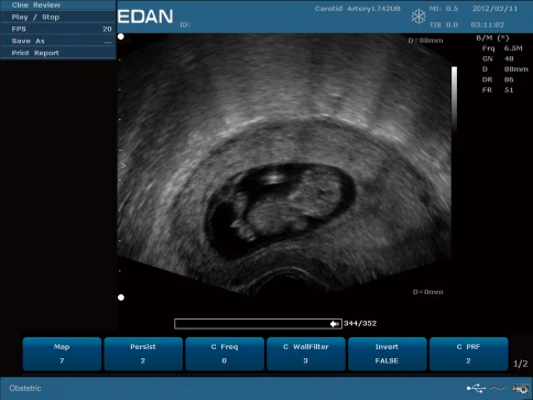 УЗИ аппарат Edan U50 Prime Edition фото 45