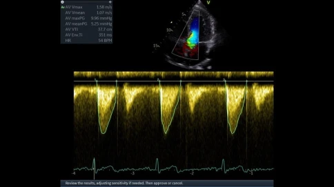 Ультразвуковая диагностическая система GE Healthcare Vivid T8 фото 8