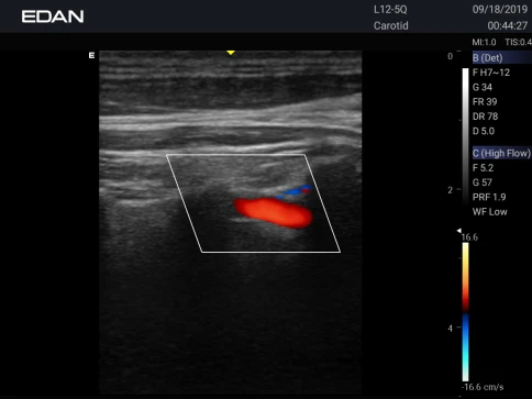 УЗИ аппарат Edan Acclarix AX3 фото 5
