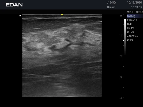 УЗИ аппарат Edan Acclarix AX3 фото 53