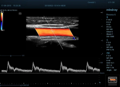 УЗИ аппарат Mindray Resona 6 Exp фото 13