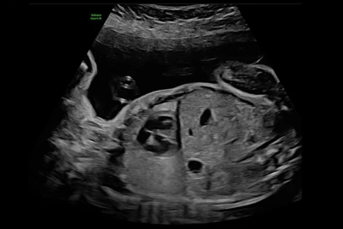 УЗИ аппарат GE HealthCare Voluson Expert 22 фото 7