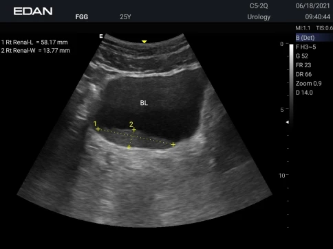 УЗИ аппарат Edan Acclarix AX3 фото 18