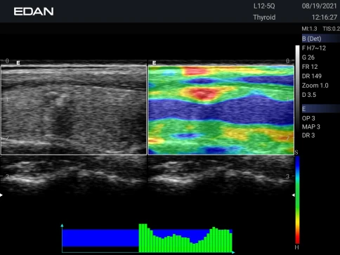 УЗИ аппарат Edan Acclarix AX3 фото 54