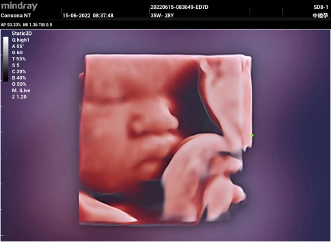 Ультразвуковая система Mindray Consona N7P фото 30