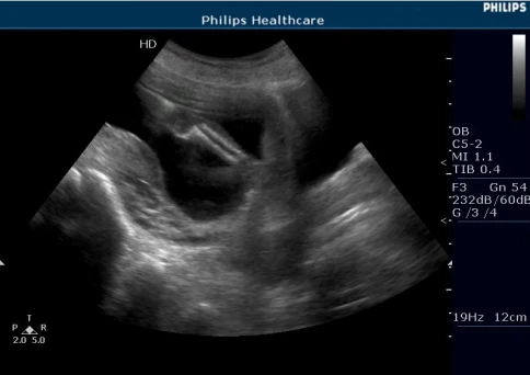 УЗИ аппарат Philips HD5 фото 8