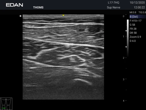 УЗИ аппарат Edan Acclarix AX3 фото 34