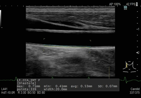 УЗИ аппарат Fujifilm Lisendo 880LE фото 9