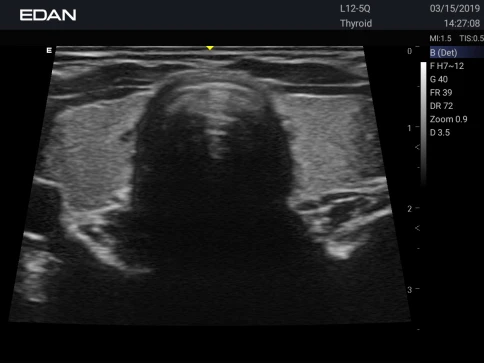 УЗИ аппарат Edan Acclarix AX3 фото 31
