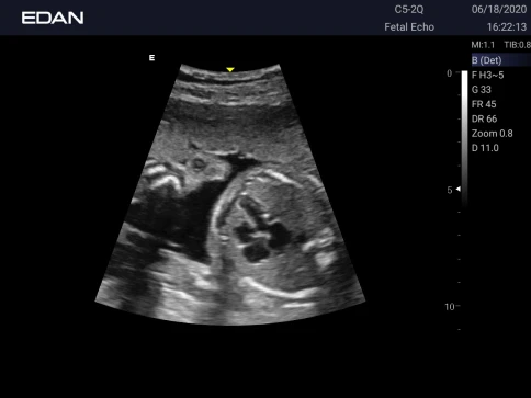 УЗИ аппарат Edan Acclarix AX3 фото 20