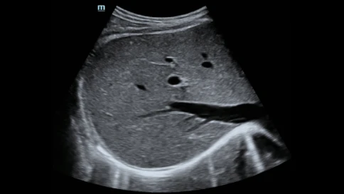 Mindray Hepatus 5 ультразвуковая система фибросканирования печени фото 7