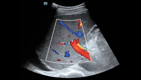 Mindray Hepatus 6 ультразвуковая система фибросканирования печени фото 10