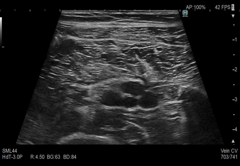 УЗИ аппарат Fujifilm Lisendo 880LE фото 2