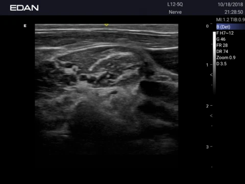 УЗИ аппарат Edan Acclarix AX3 фото 63
