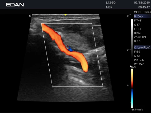 УЗИ аппарат Edan Acclarix AX3 фото 56