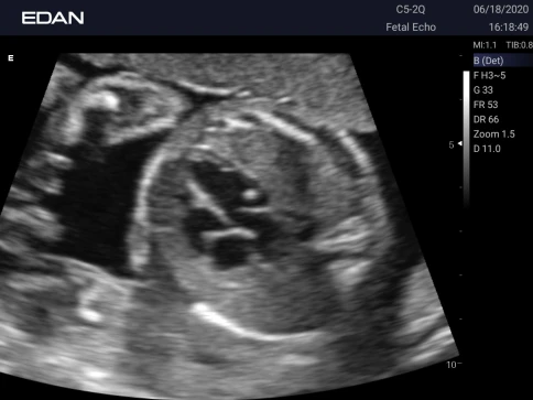 УЗИ аппарат Edan Acclarix AX3 фото 41
