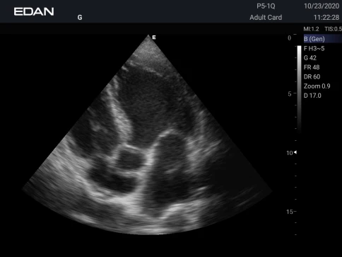 УЗИ аппарат Edan Acclarix AX3 фото 15