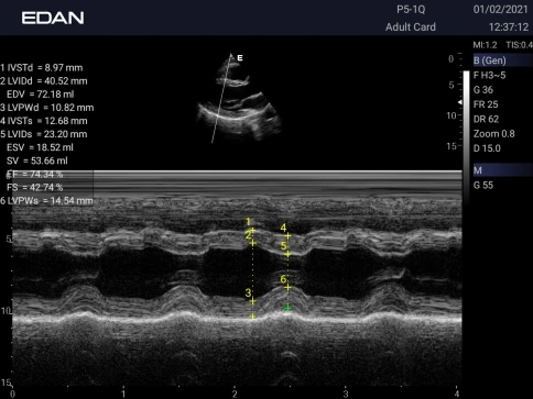 УЗИ аппарат Edan Acclarix AX3 фото 10
