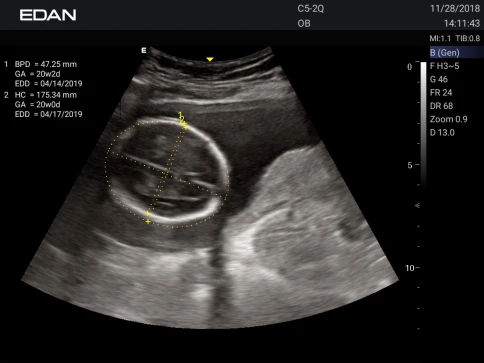 УЗИ аппарат Edan Acclarix AX3 фото 37