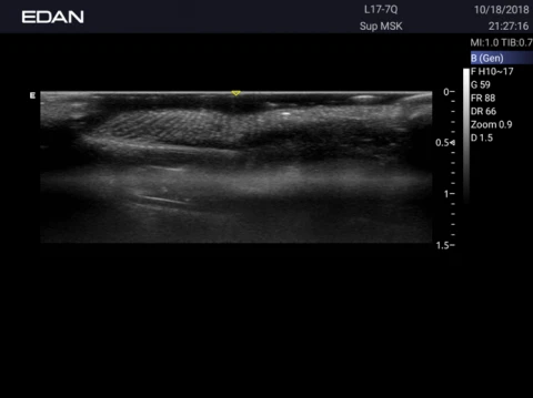 УЗИ аппарат Edan Acclarix AX3 фото 64