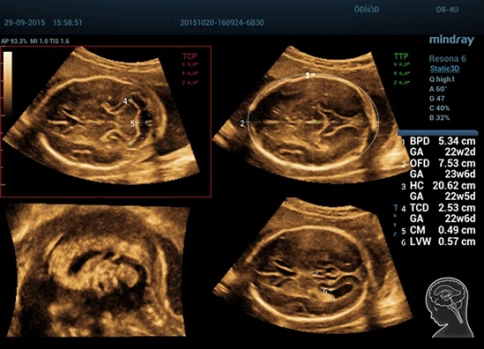 УЗИ аппарат Mindray Resona 6 Exp фото 9