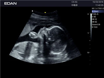 УЗИ аппарат Edan Acclarix AX2 фото 6