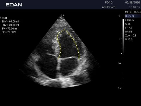УЗИ аппарат Edan Acclarix AX3 фото 11