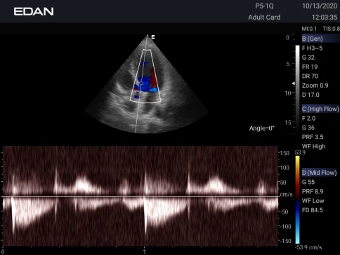 УЗИ аппарат Edan Acclarix AX3 фото 12