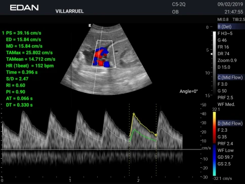 УЗИ аппарат Edan Acclarix AX3 фото 22