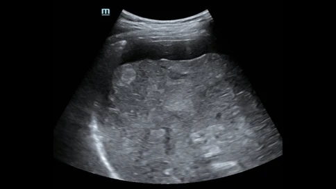 Mindray Hepatus 6 ультразвуковая система фибросканирования печени фото 9